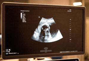 usg 2d - perbedaan usg 2d 3d 4d 5d